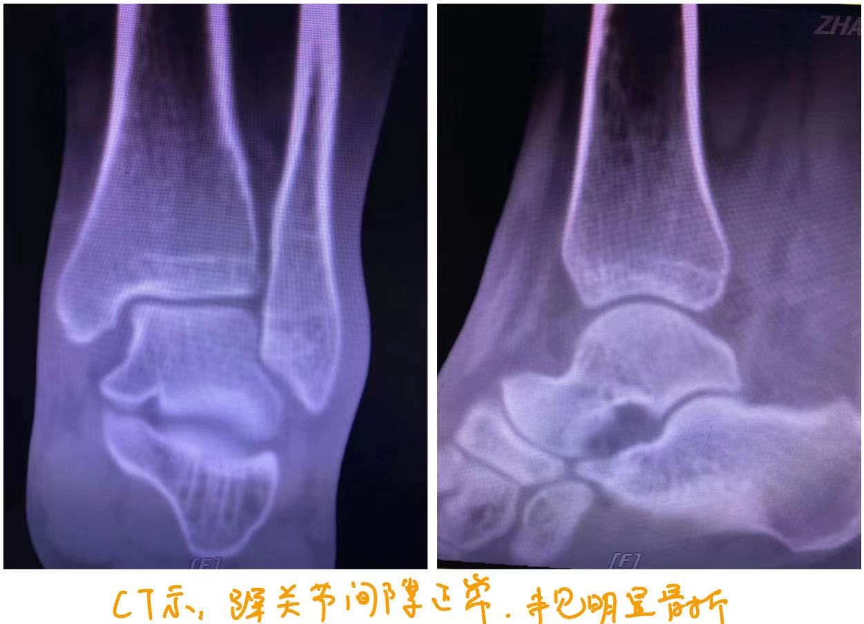 脚踝外伤引起软组织损伤，规范治疗后好转