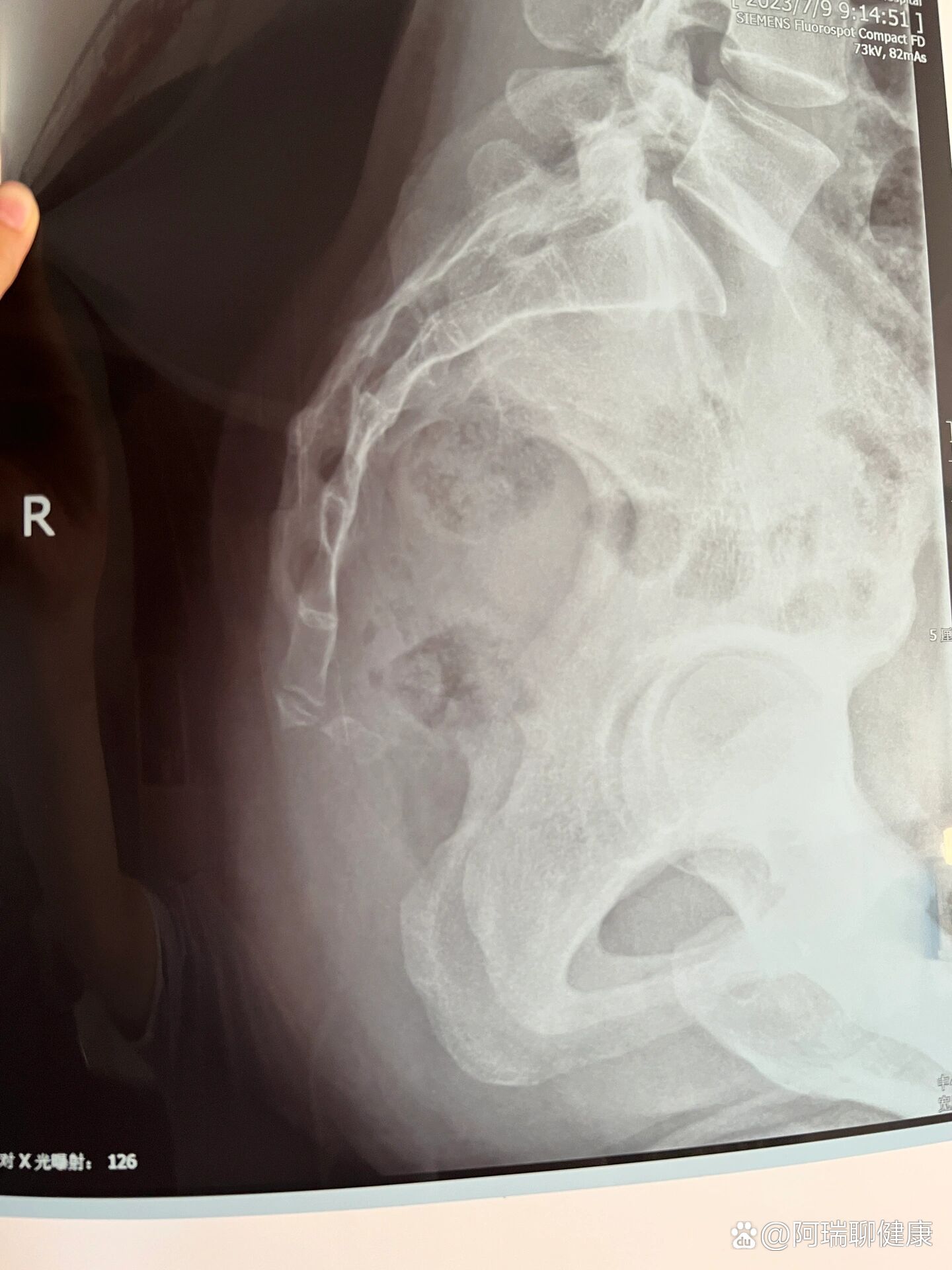 产后持续尾骨凸出,疼痛,原来是尾椎脱位!