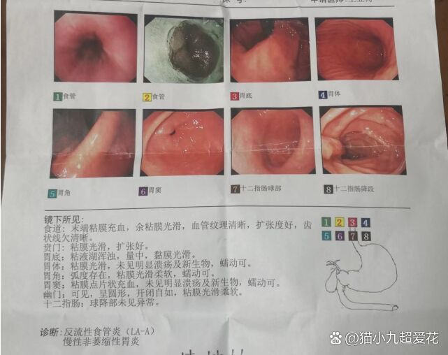 反流性食管炎 慢性非萎缩性胃炎