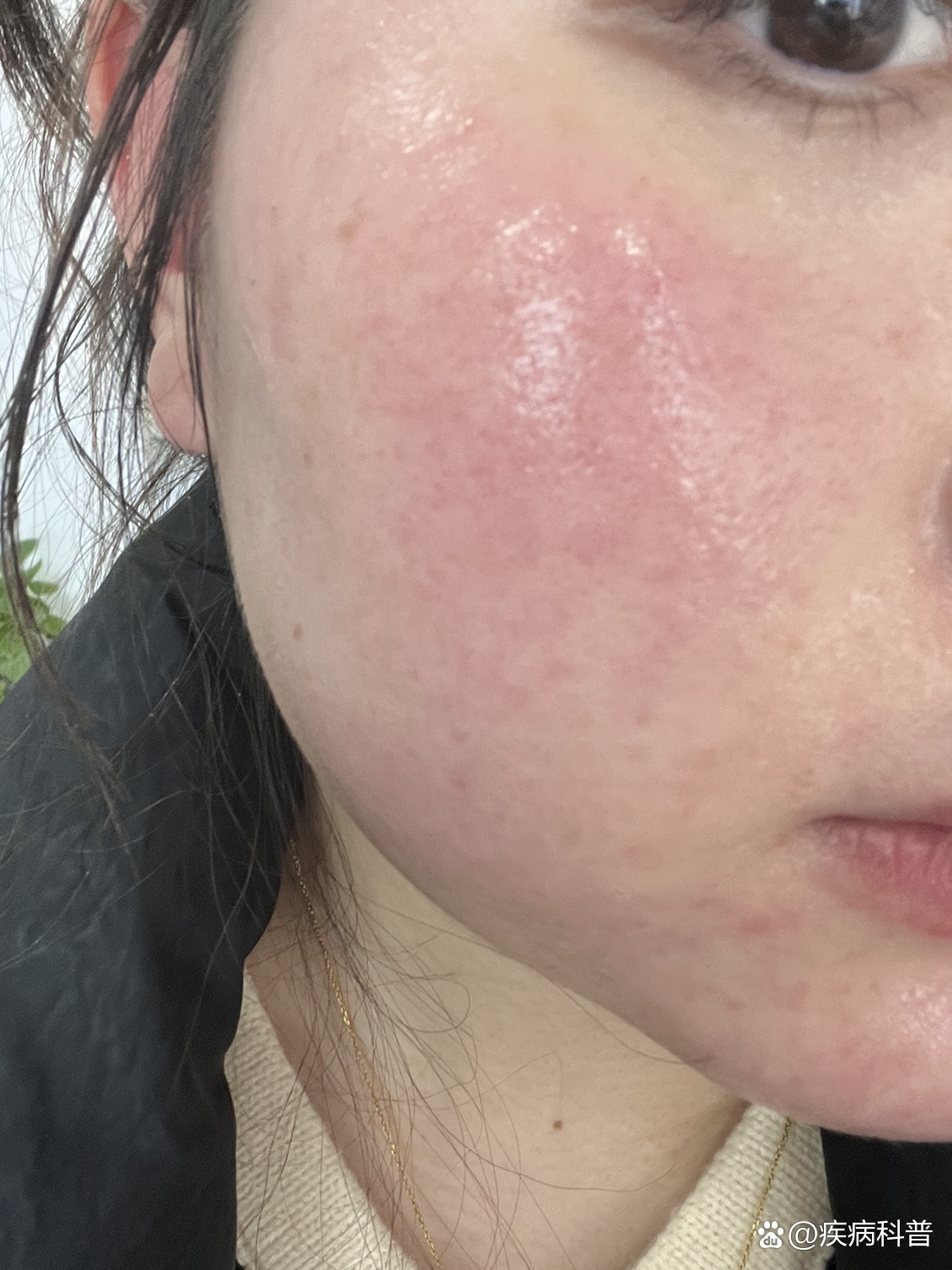 去了趟皮肤科才明白,原来去红血丝这么简单