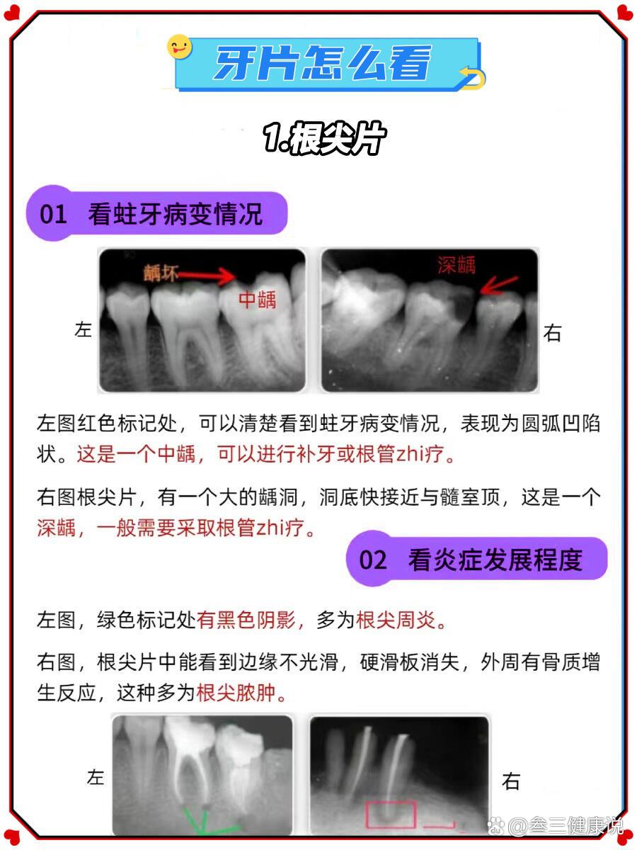 牙片怎么看?