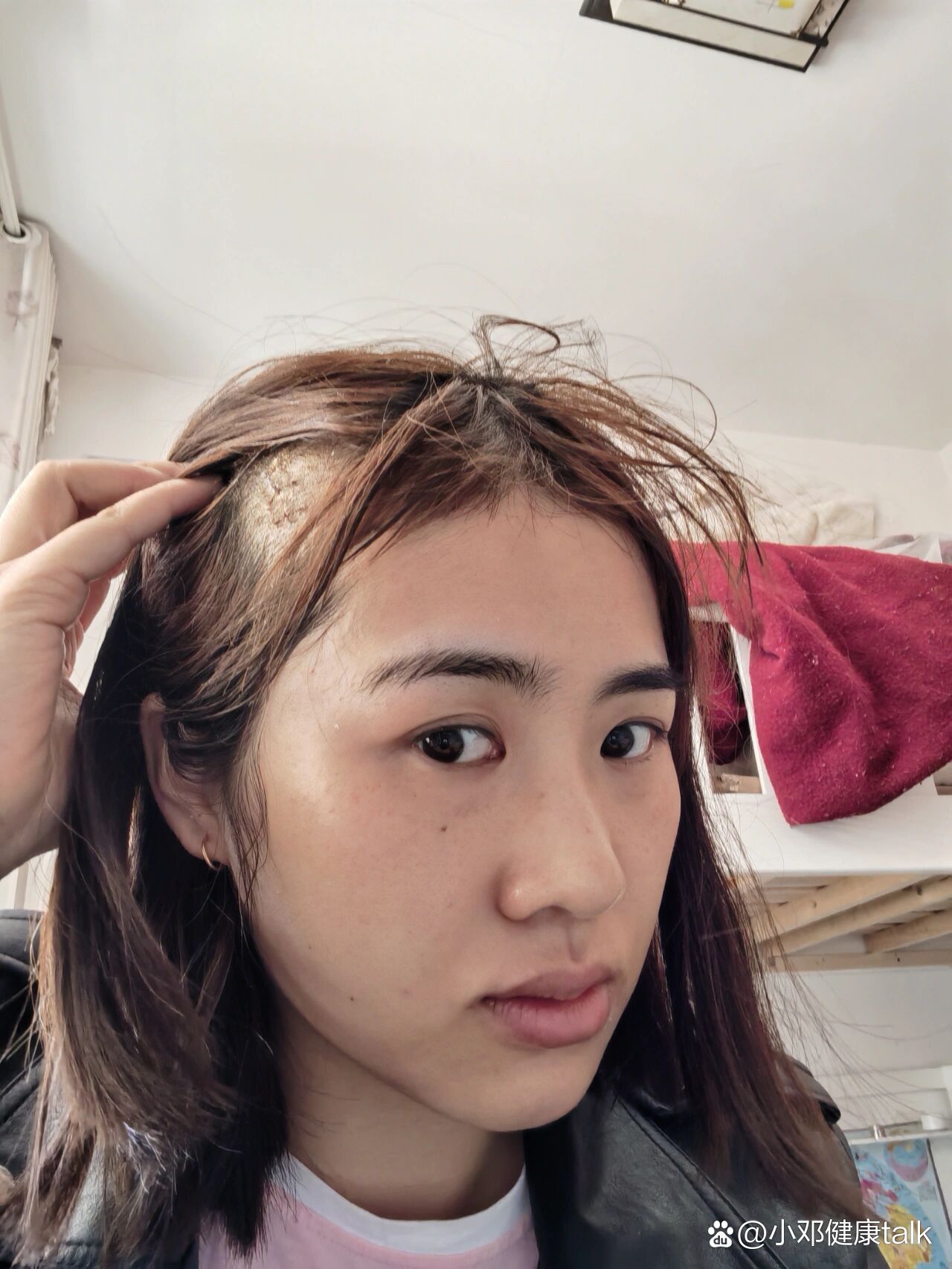 大家有私信我这个关于颅骨骨瘤,这个是手术后第10天,感觉恢复还不错