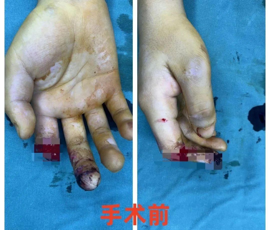 手指不幸离断"全形再造术"还伤者健全手指