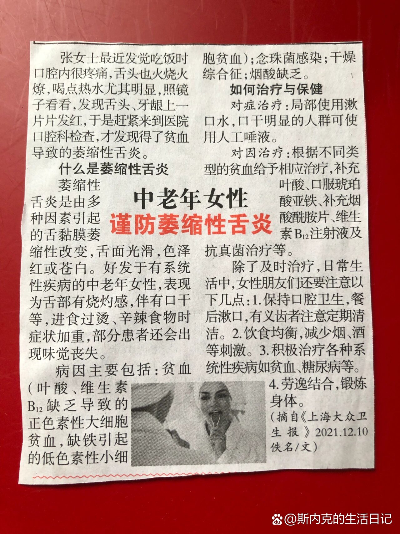 养生摘录中老年女性谨防萎缩性舌炎