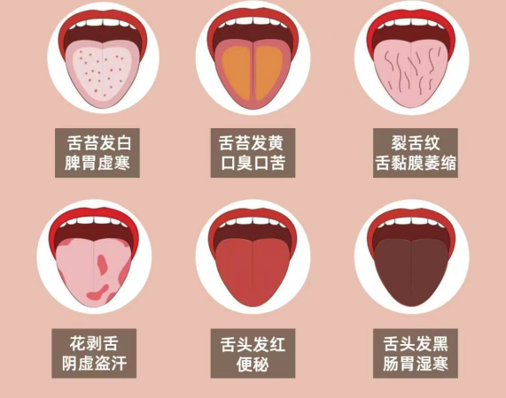 舌边有齿痕,中医教大家如何分辨你是什么体质