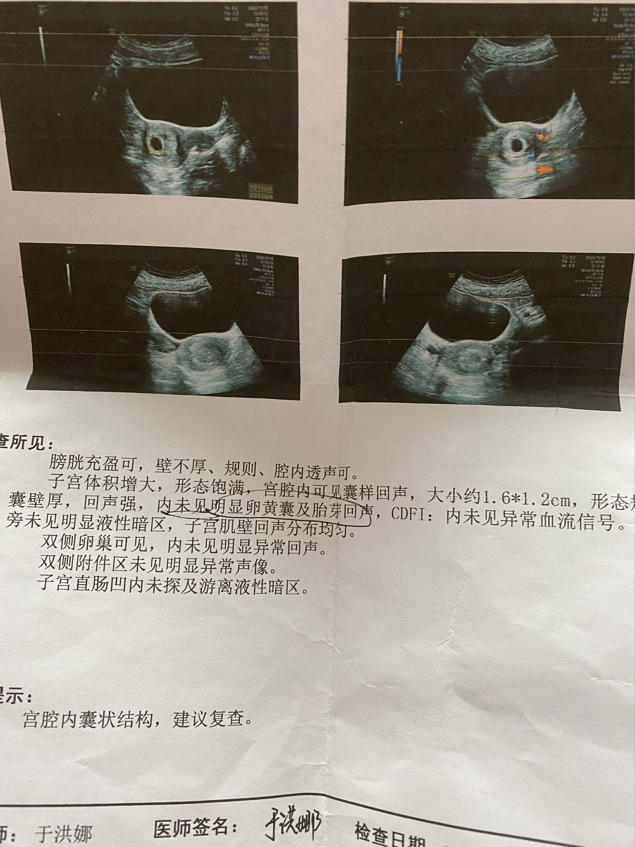 八周终于看到卵黄囊胎心胎芽,来还愿啦!