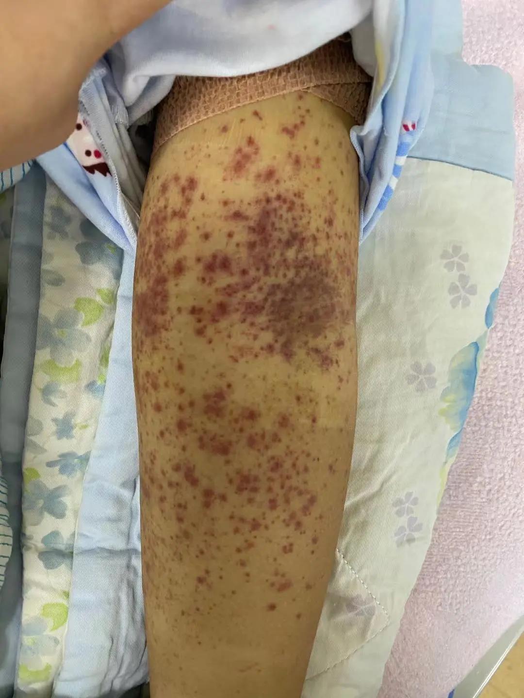 这位患者最近发现腿上莫名出现很多红点,经检查是血小板减少性紫癜.