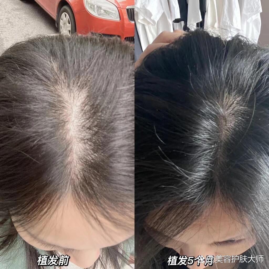 关于植发发缝恢复全记录的信息