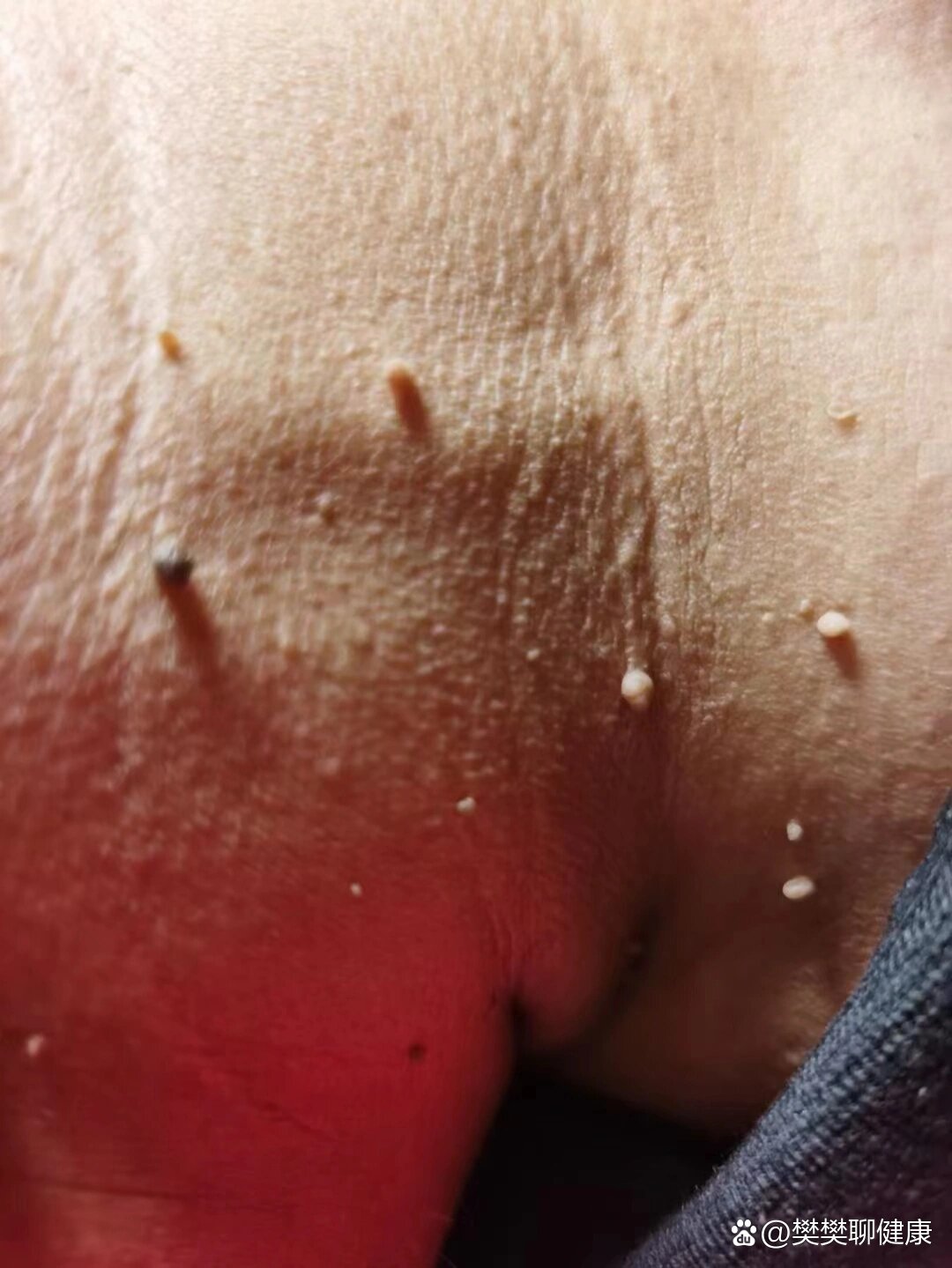 你身上有这样的丝状疣嘛?