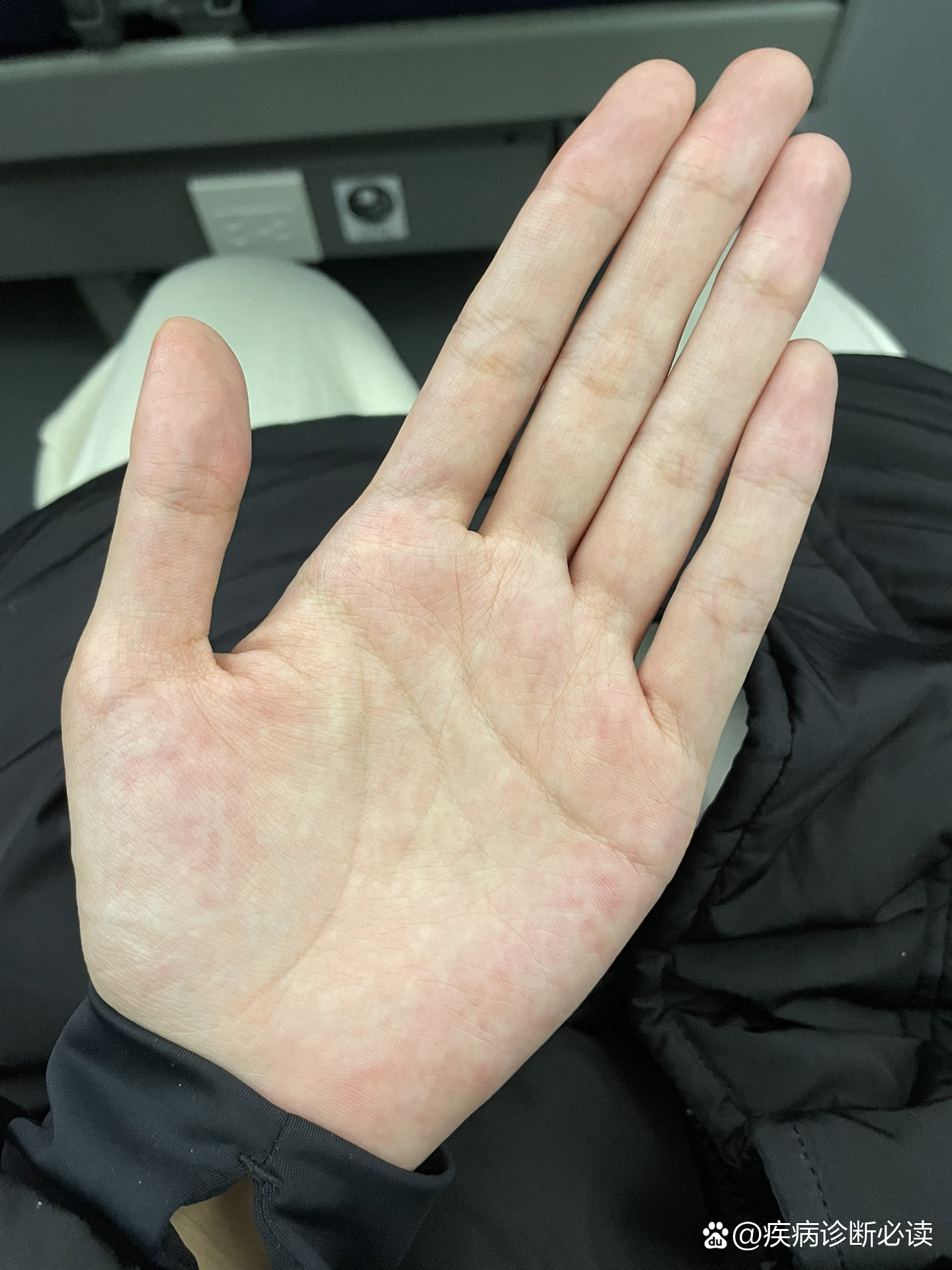 出差路上刷到马凡综合征整个人都不好了01