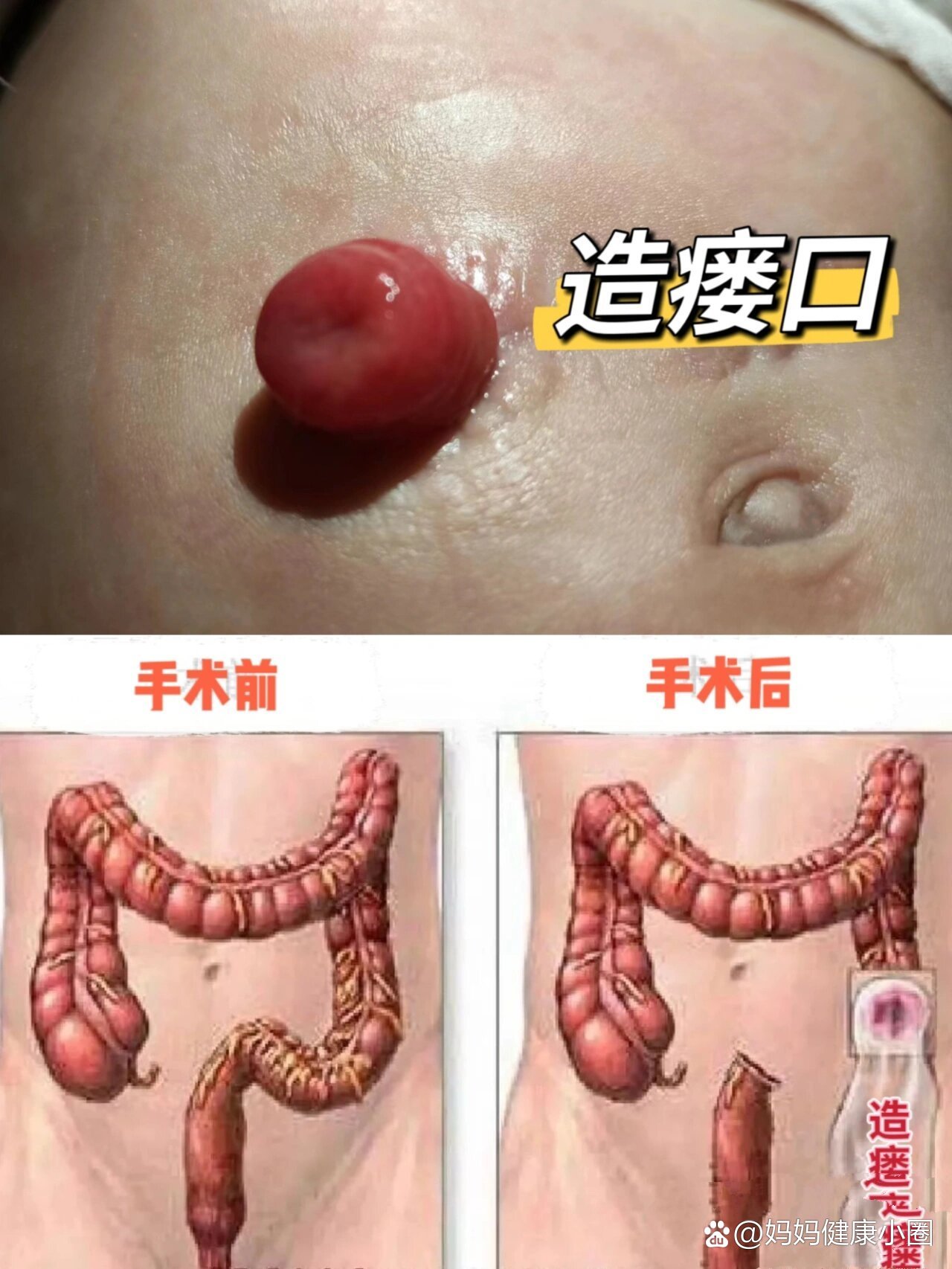 早产宝宝做肠造瘘手术能恢复正常吗