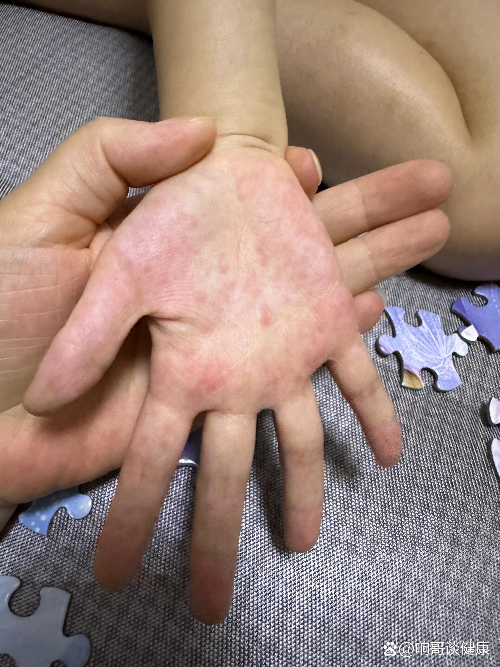 洗澡时发现手心红点点