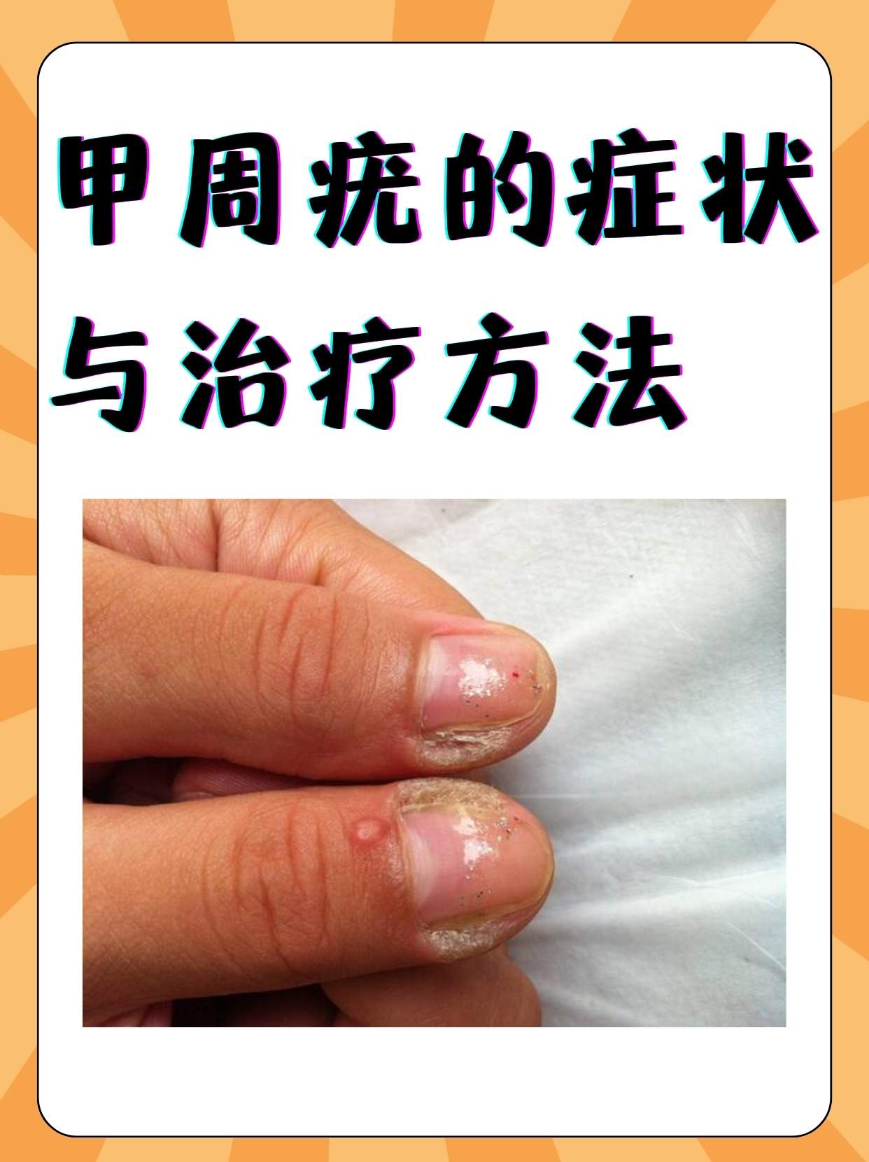 甲周疣的症状与治疗方法