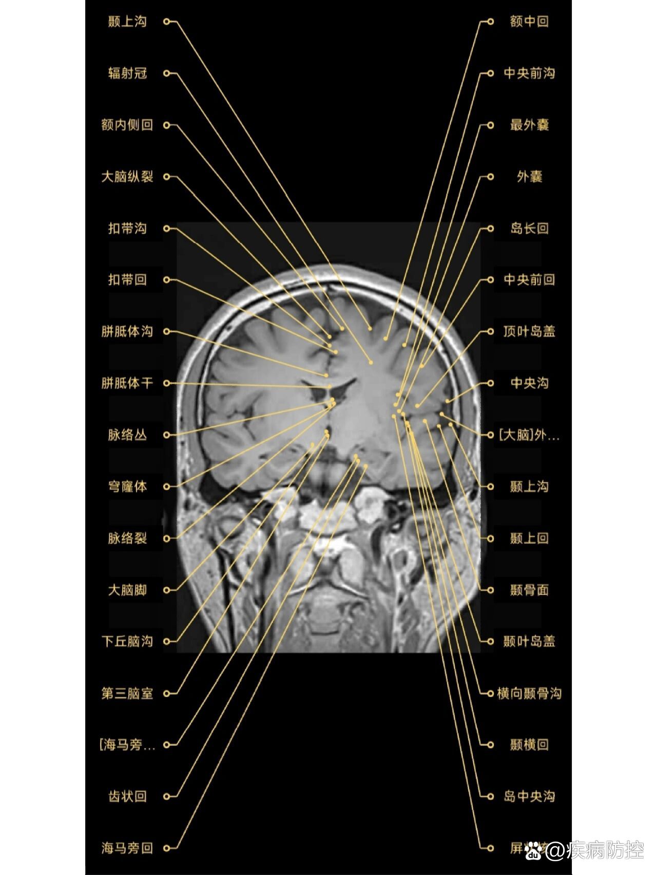 颅脑mr解剖-第三脑室