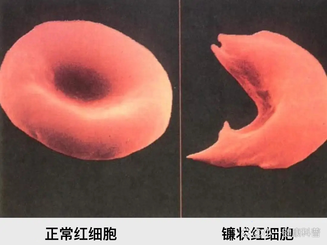 是1949年世界上最早发现的第一个分子病,因红细胞呈镰刀状而得名