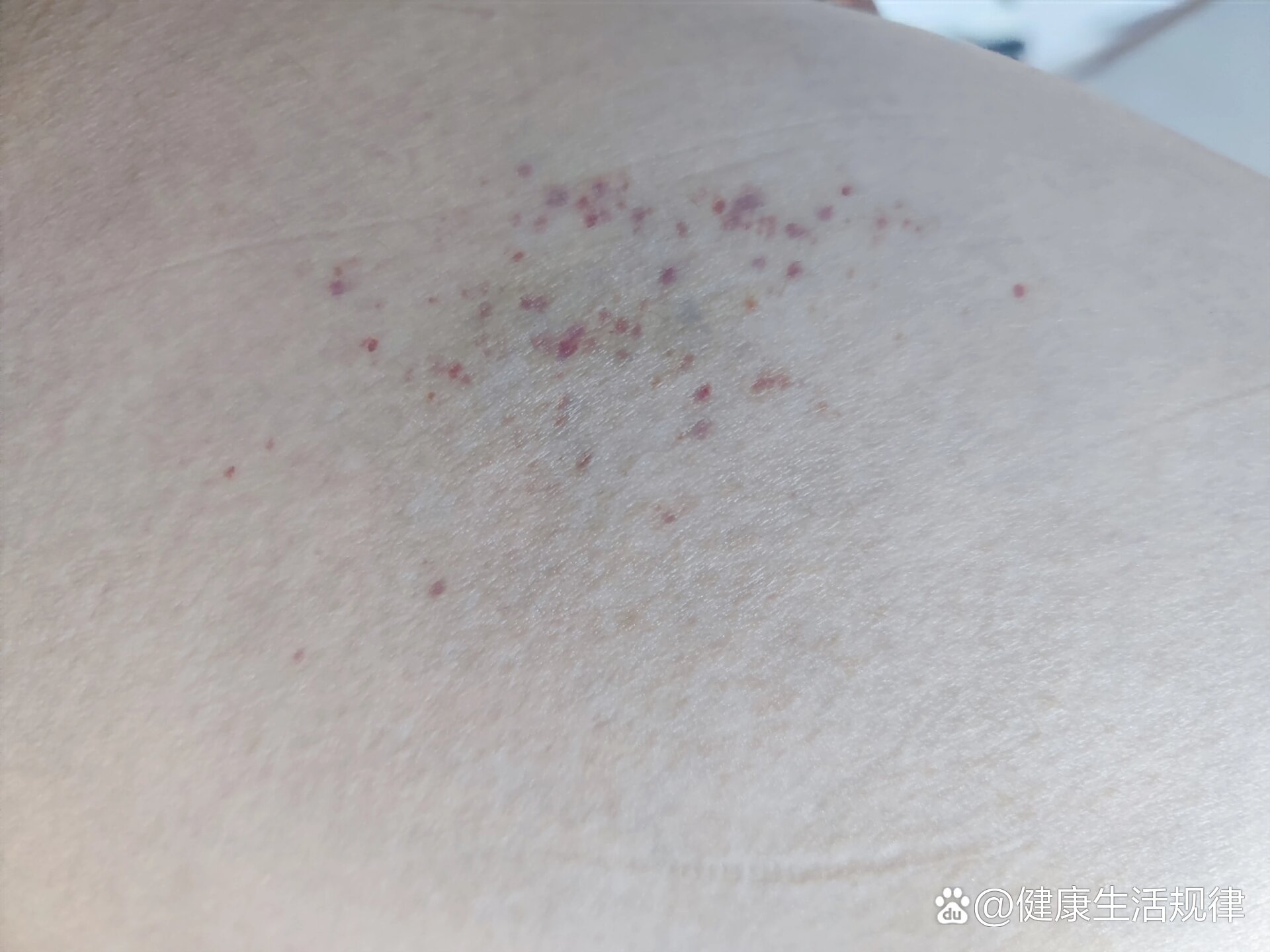  p>大腿上挠出这种血斑 br>大腿上挠一挠,就出现这种像瘀血一样的斑点