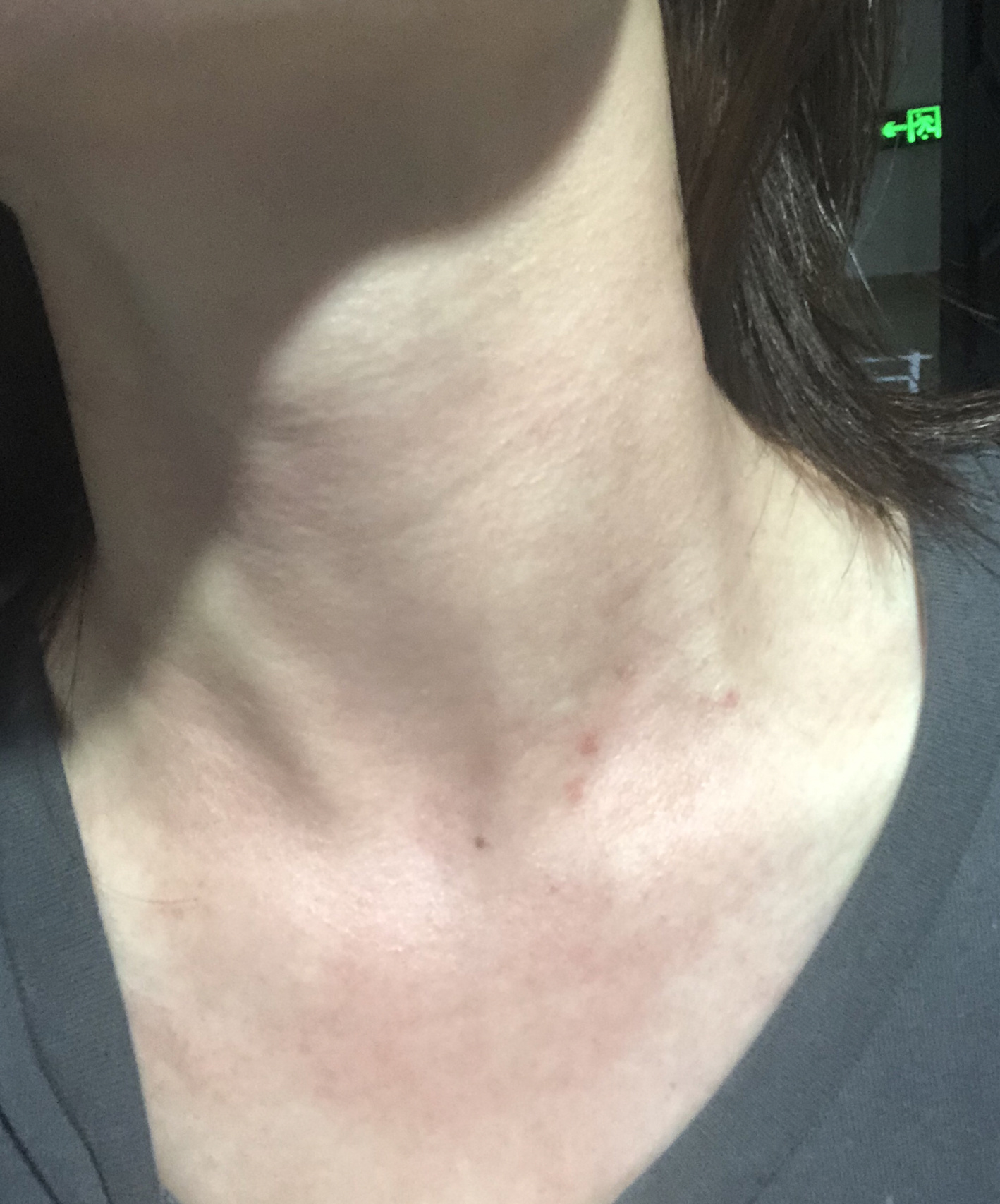 脖子过敏怎么办