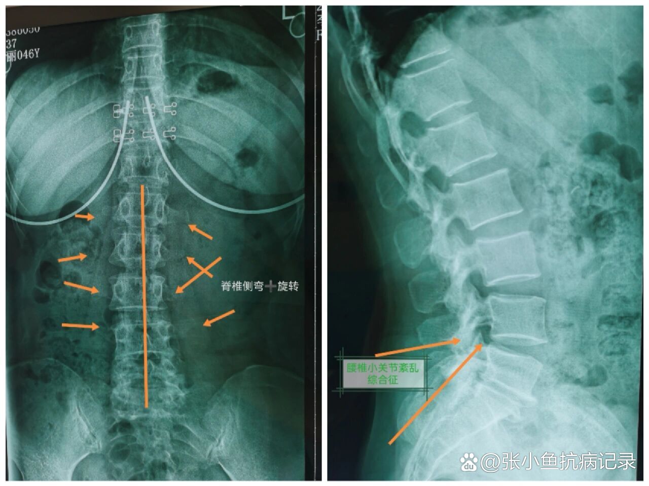 腰椎小关节紊乱