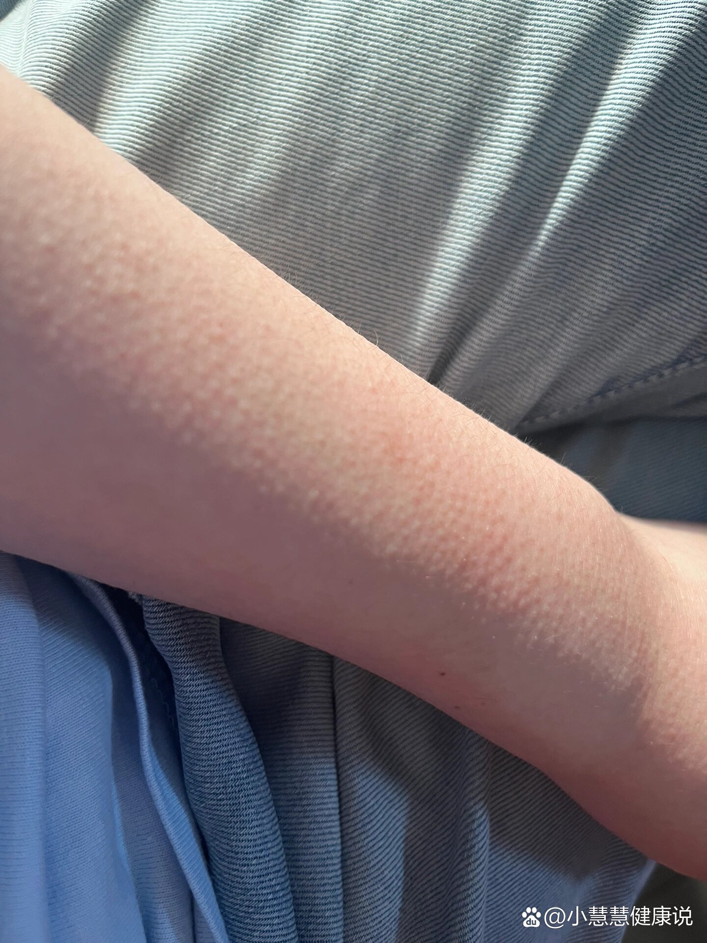 胳膊上起疙瘩!