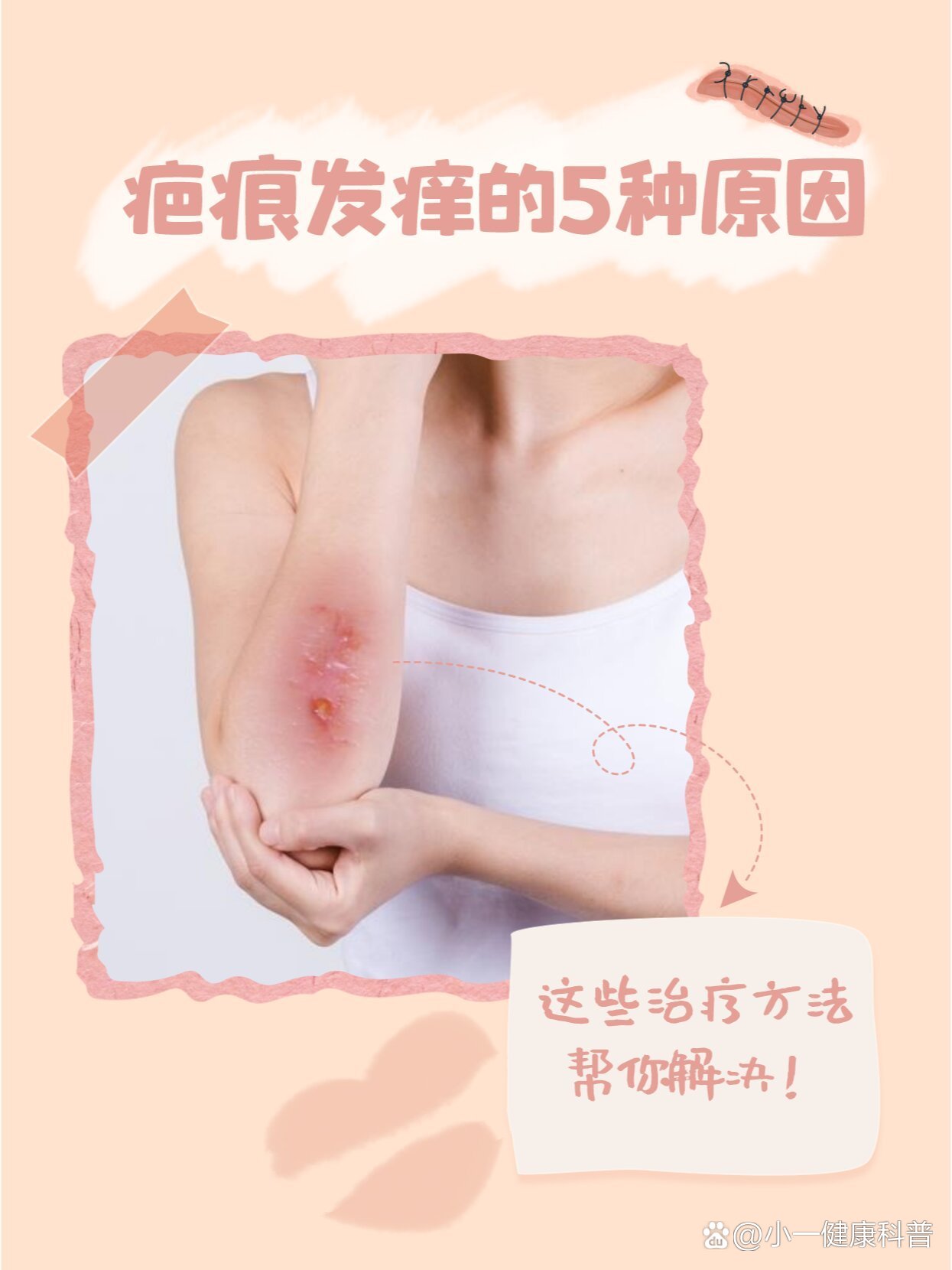  p>疤痕发痒的5种原因,这些治疗方法帮你解决 br>伤口愈合时出现疤痕