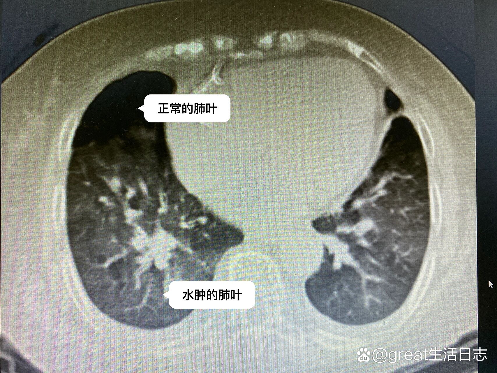 肺水肿CT图片