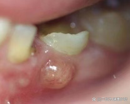 牙龈长脓包,不只是个小包包那么简单!