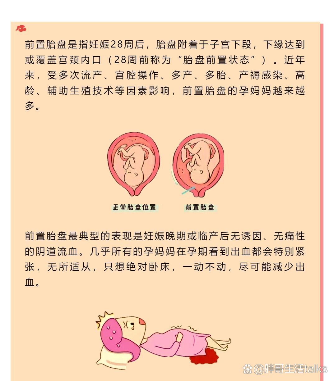 前置胎盘图解图片