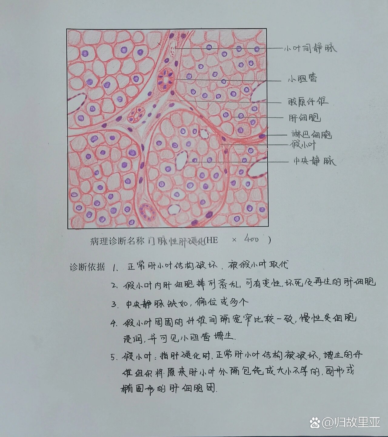 门脉性肝硬化