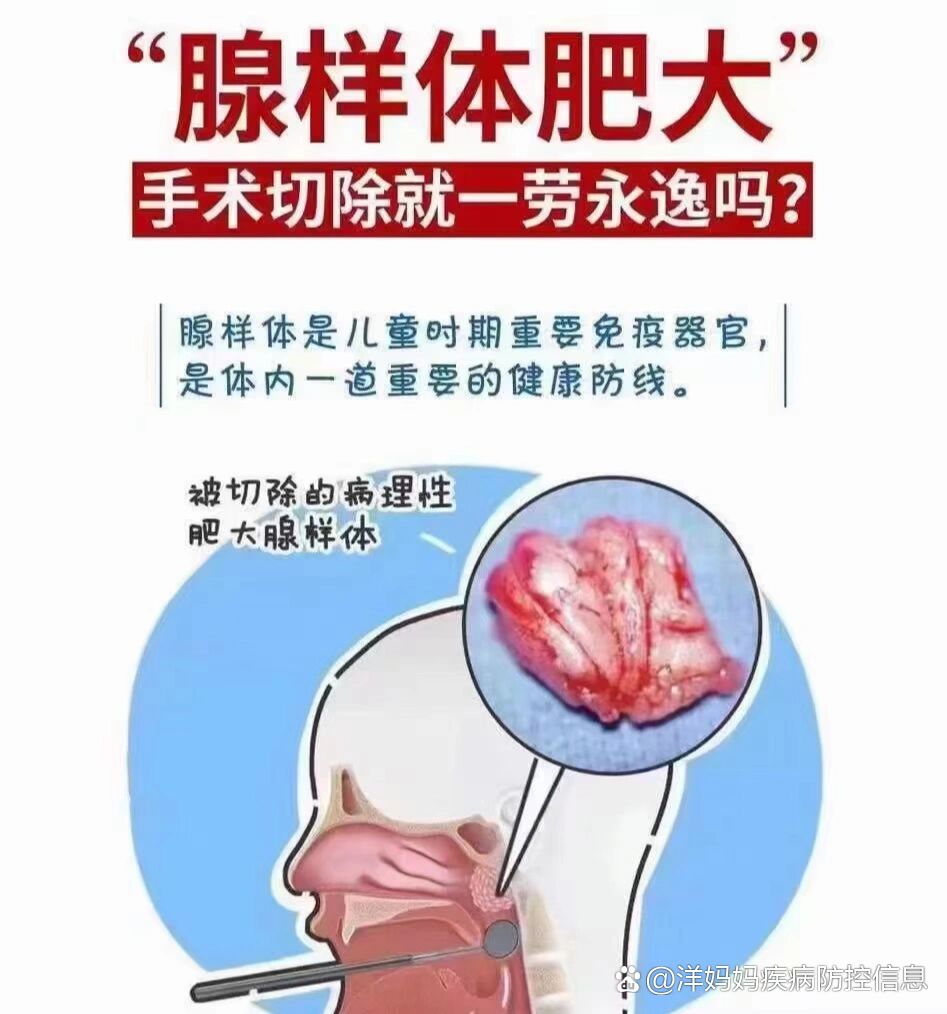 腺样体肥大直接切除就一劳永逸吗?