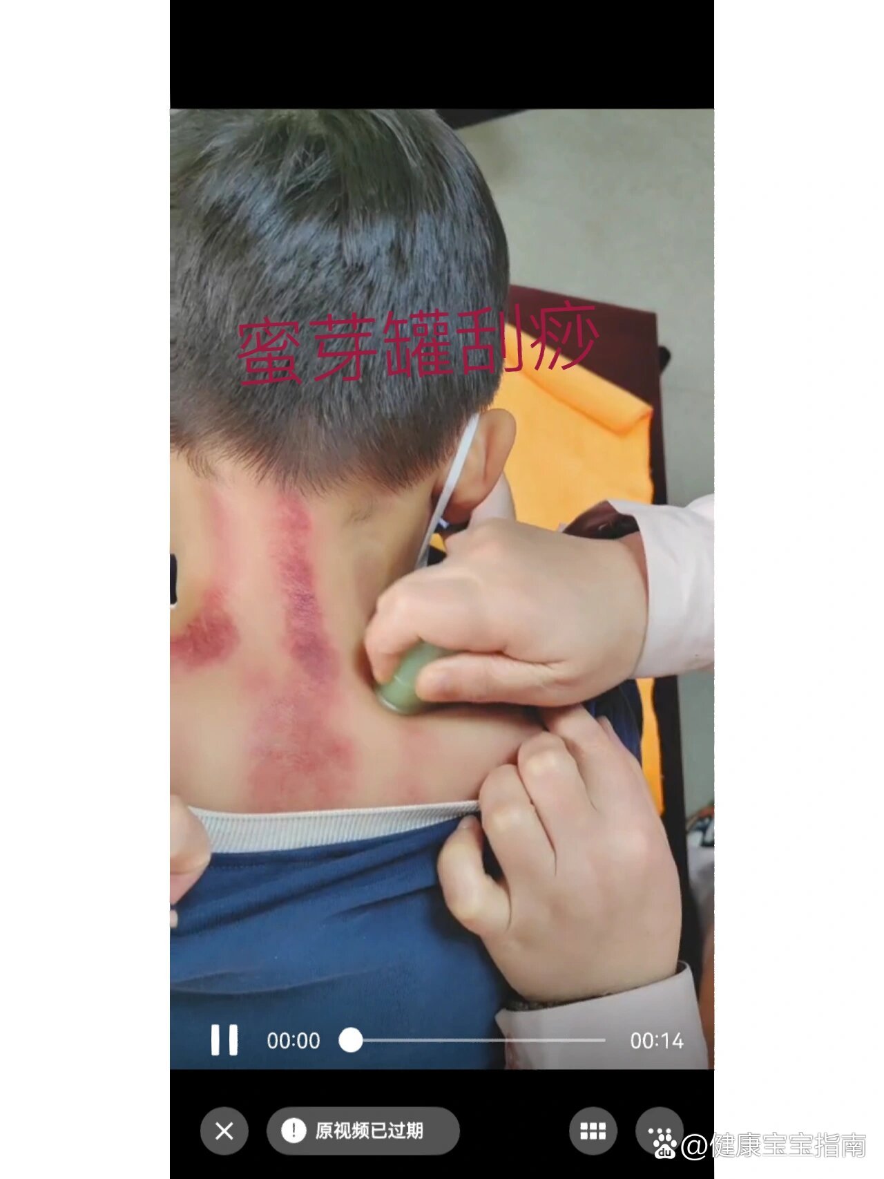 不退的小孩,家长非常着急,在家可以给小朋友在大椎,肺俞穴周围刮痧,能