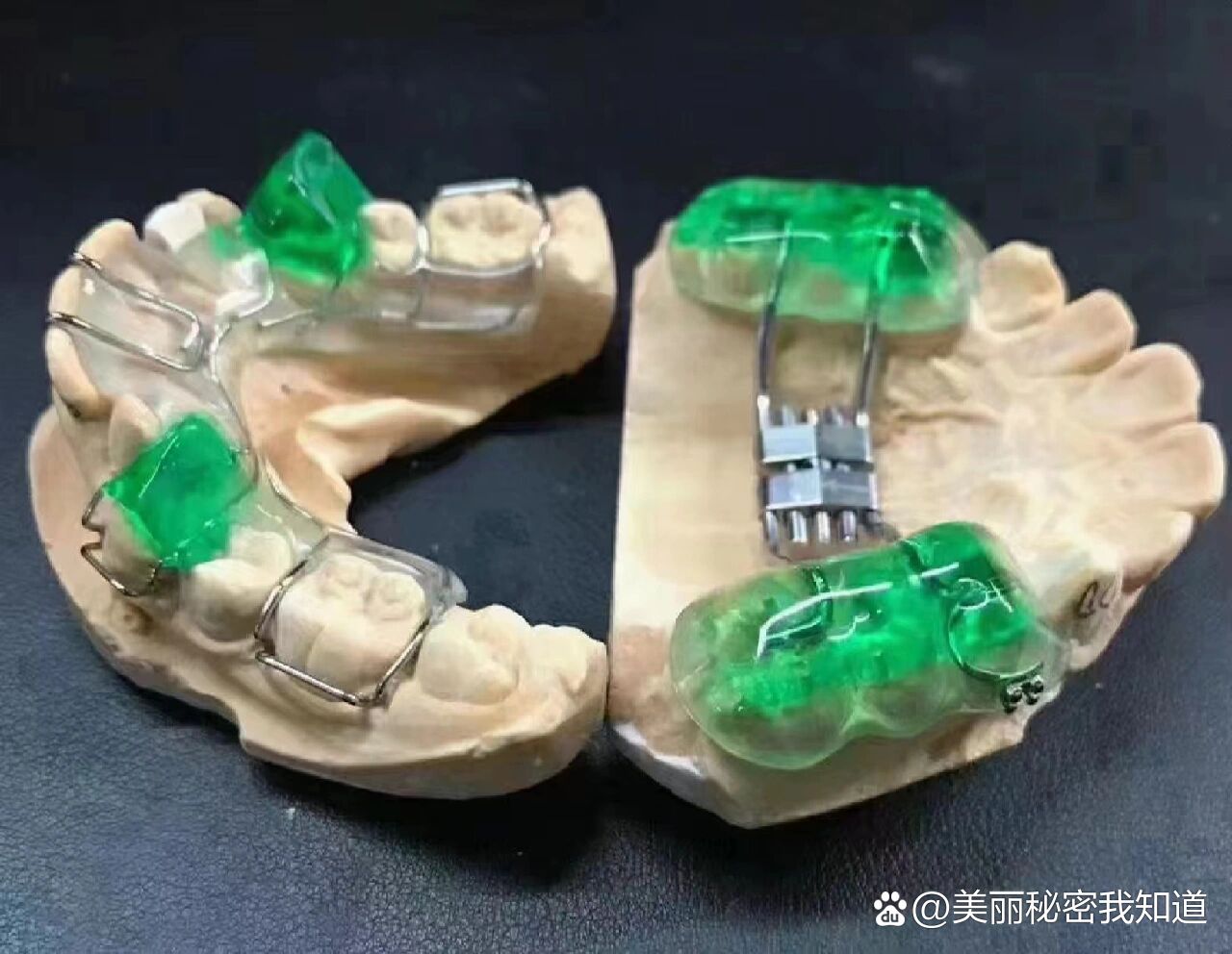 牙齿矫正sgtb矫正器也称双导面矫正器➕快速扩弓器