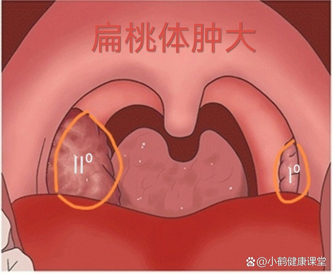 怎么看喉咙发炎图片