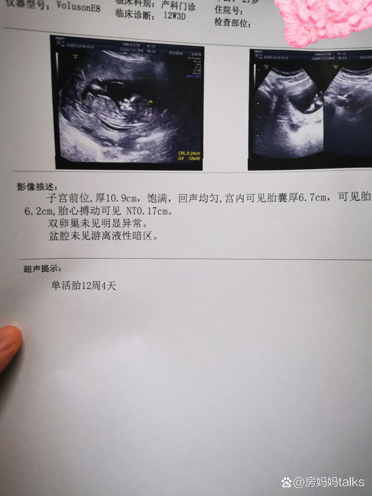 12周nt彩超照片