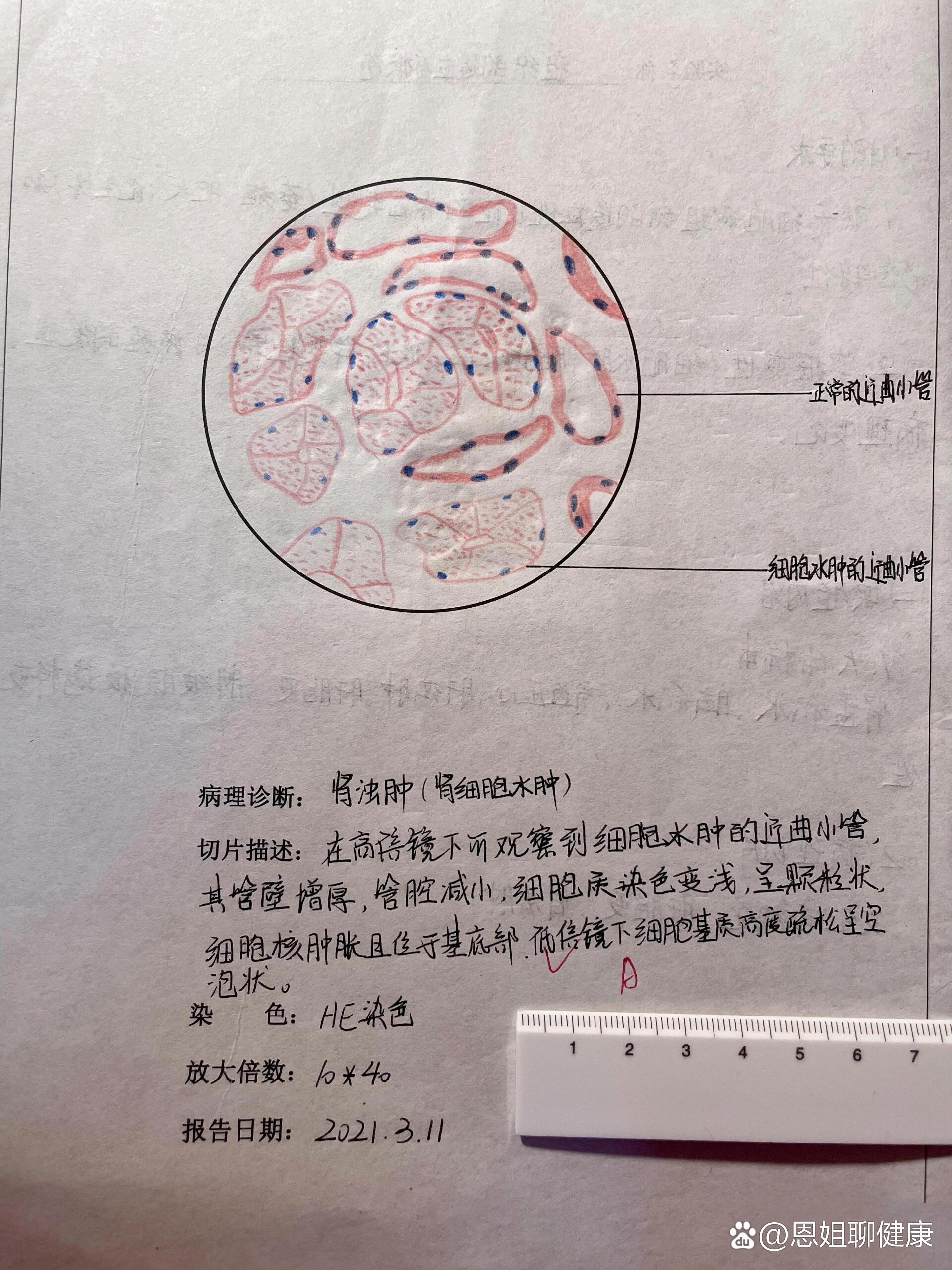 肾结核手绘图图片