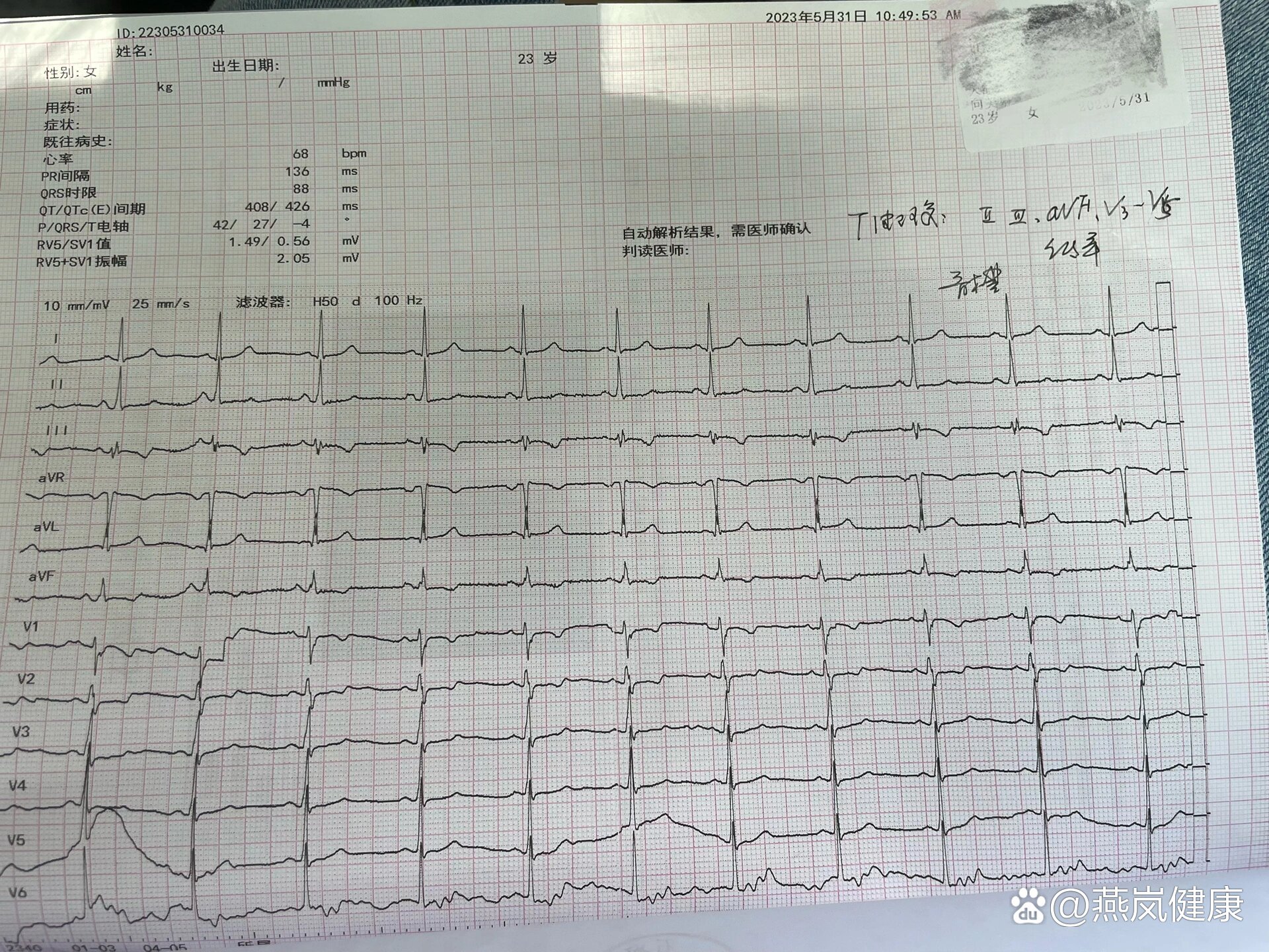 心电图异常t波图片