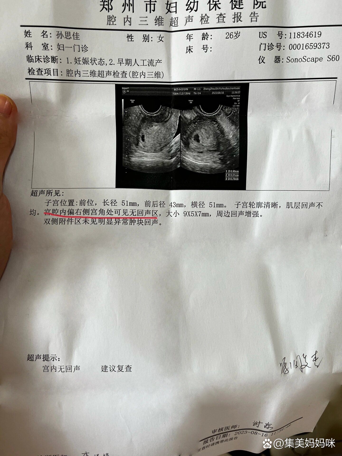 孕囊位置偏右?