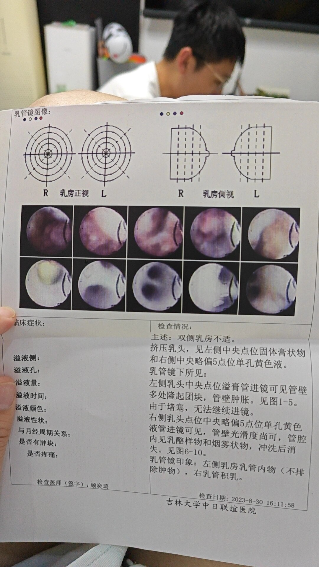 乳管镜检查图片