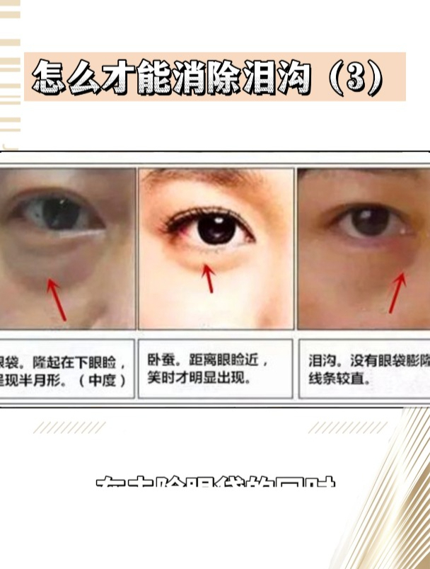 怎么才能去泪沟3