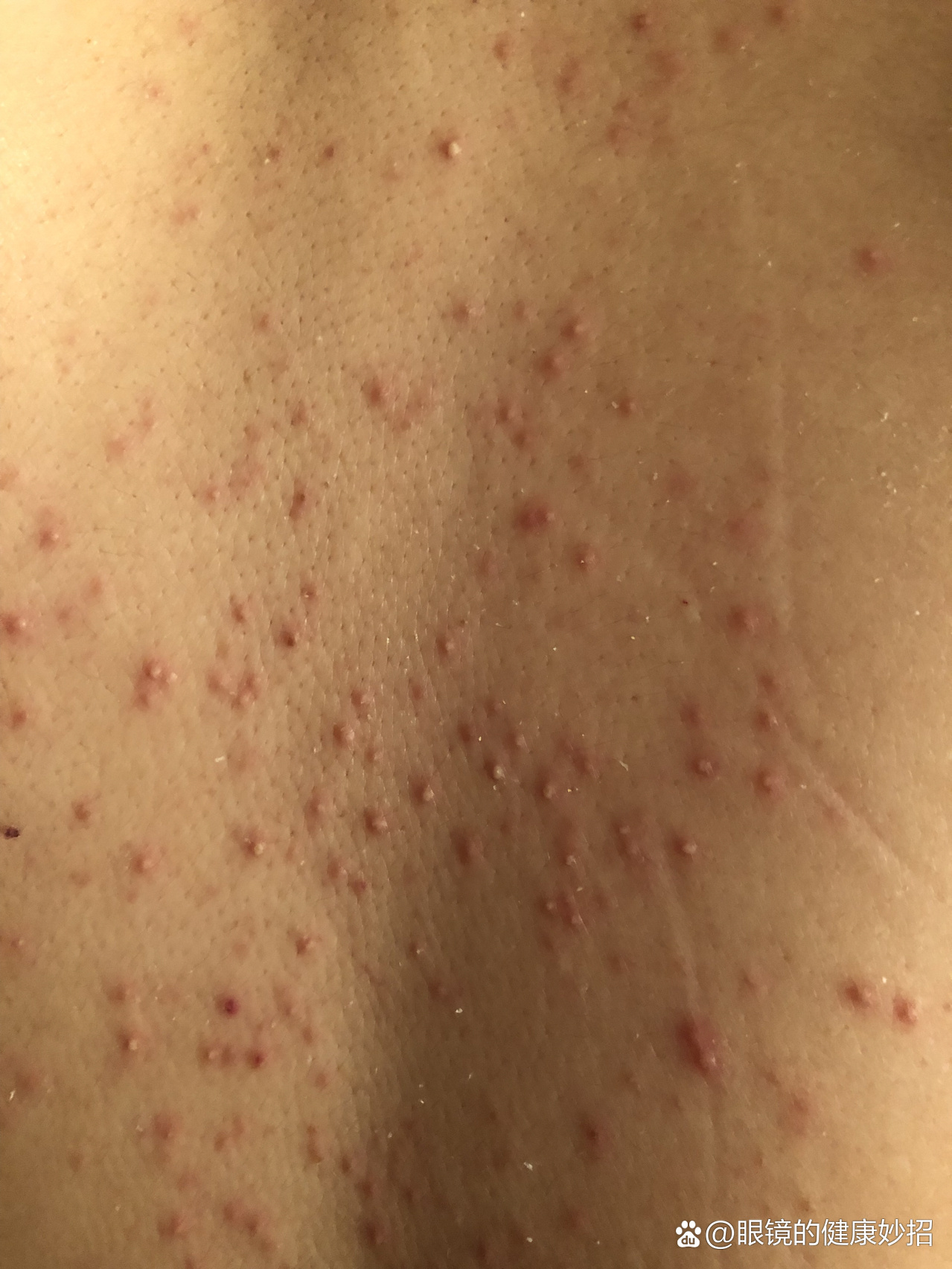 糠秕孢子性毛囊炎