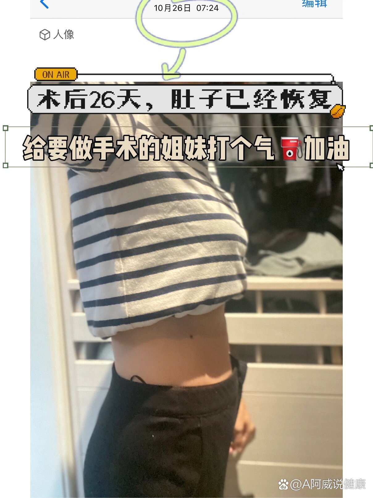 子宫肌瘤腹腔镜术后恢复以及生活的注意事项