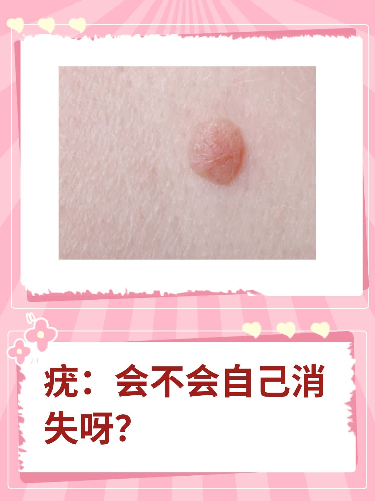疣:会不会自己消失呀