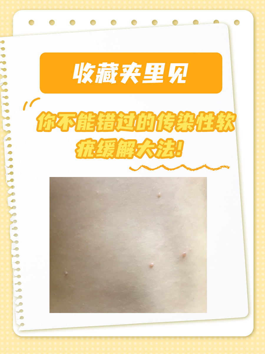 收藏夹里见|你不能错过的传染性软疣缓解大法!