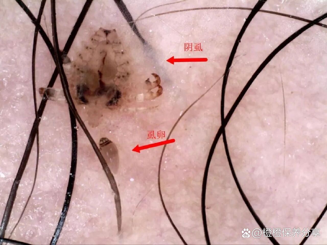阴虱治疗期间注意事项: 1,治疗阴虱期间内裤必须每天换洗并开水滔洗