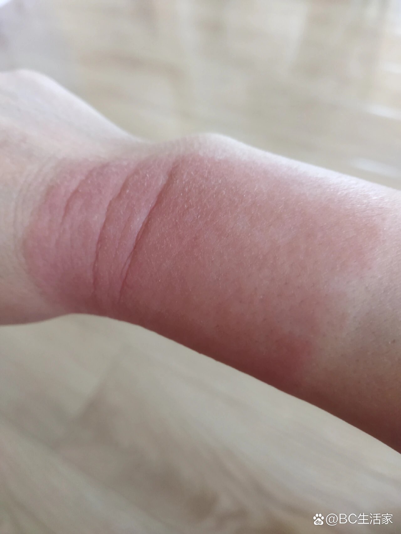 风湿膏过敏怎么办?