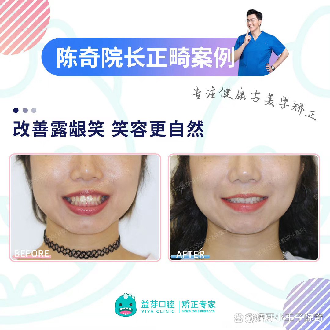 【什么是笑线？