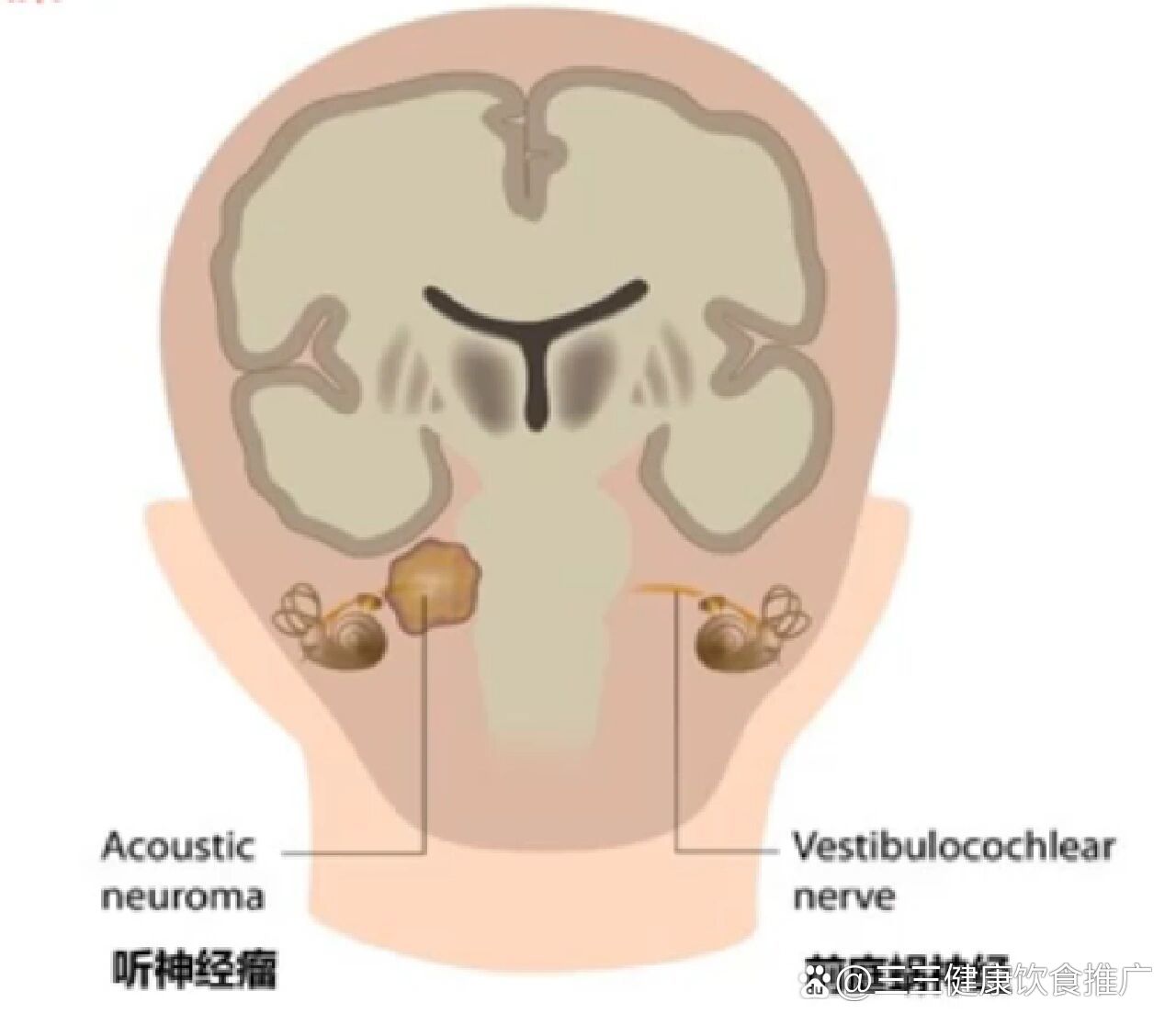 什么是听神经瘤?