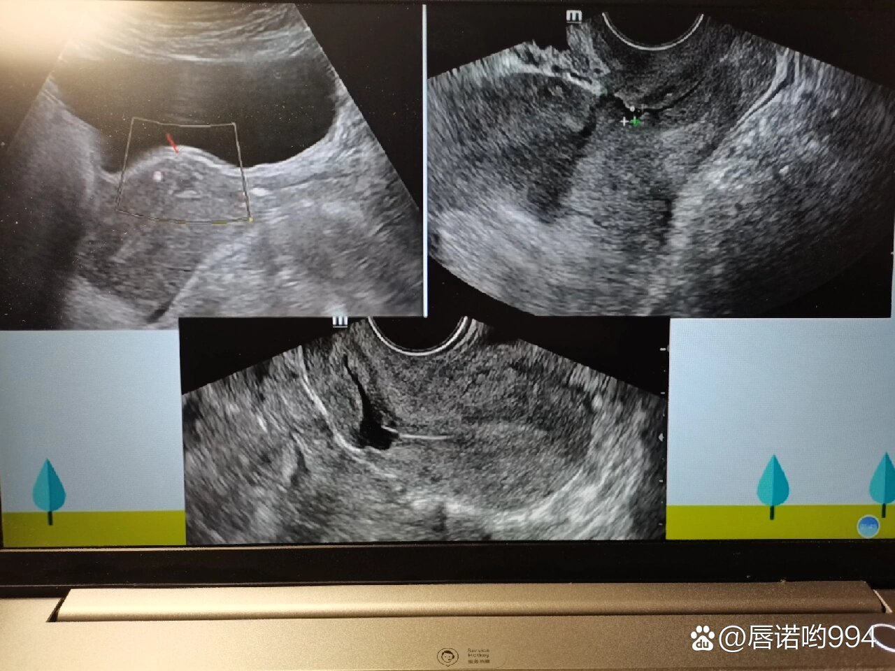 瘢痕子宫超声图片