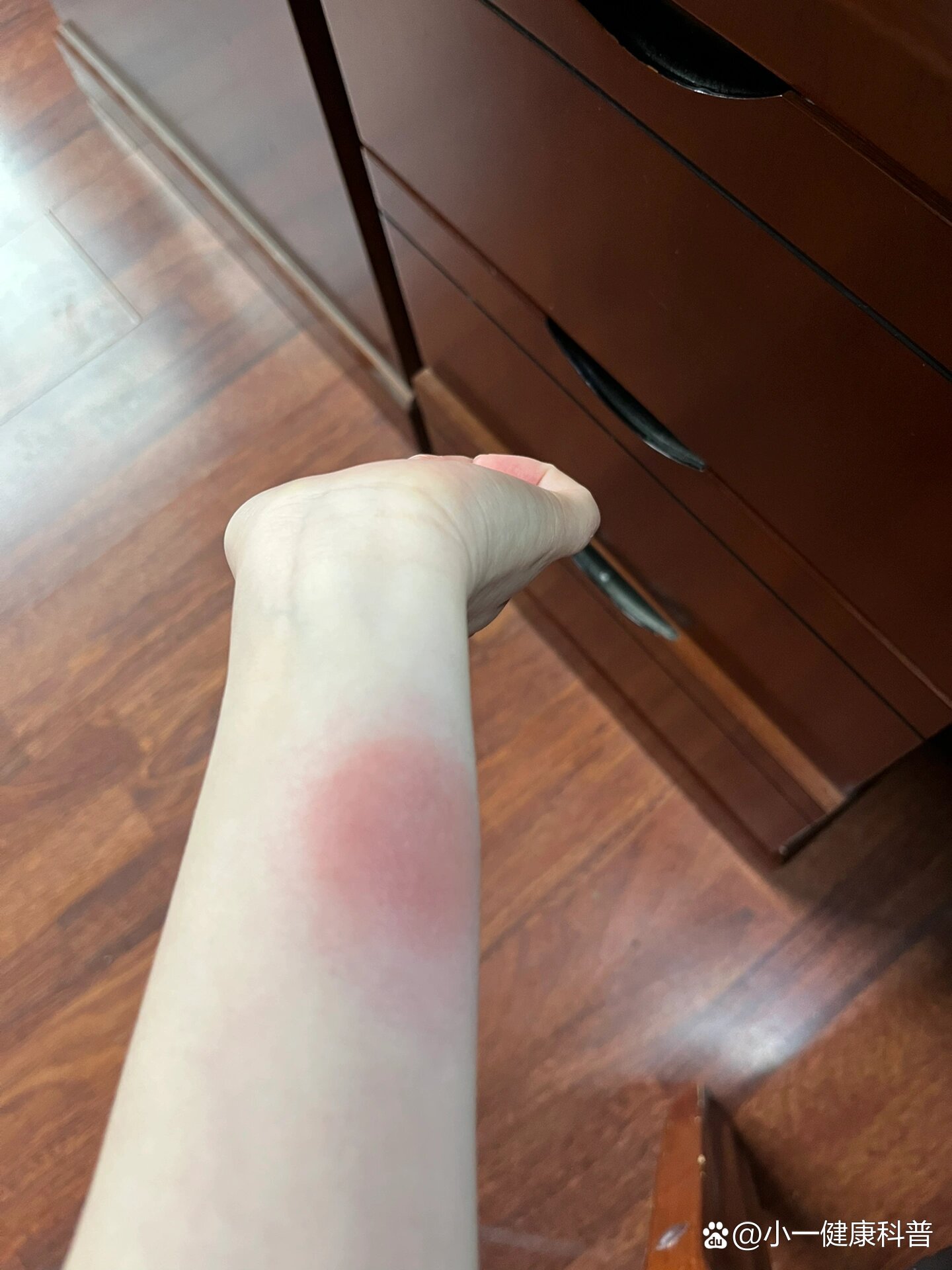 破伤风皮试过敏了怎么办