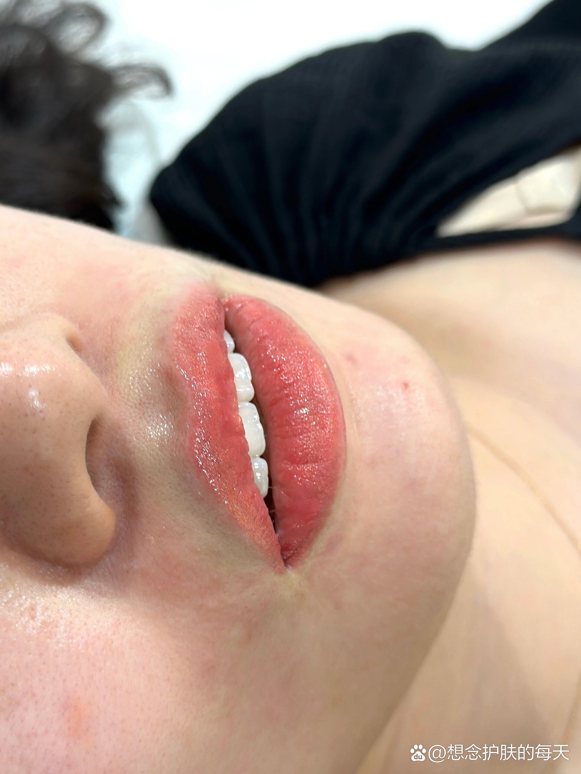 老式纹唇改马生少女唇