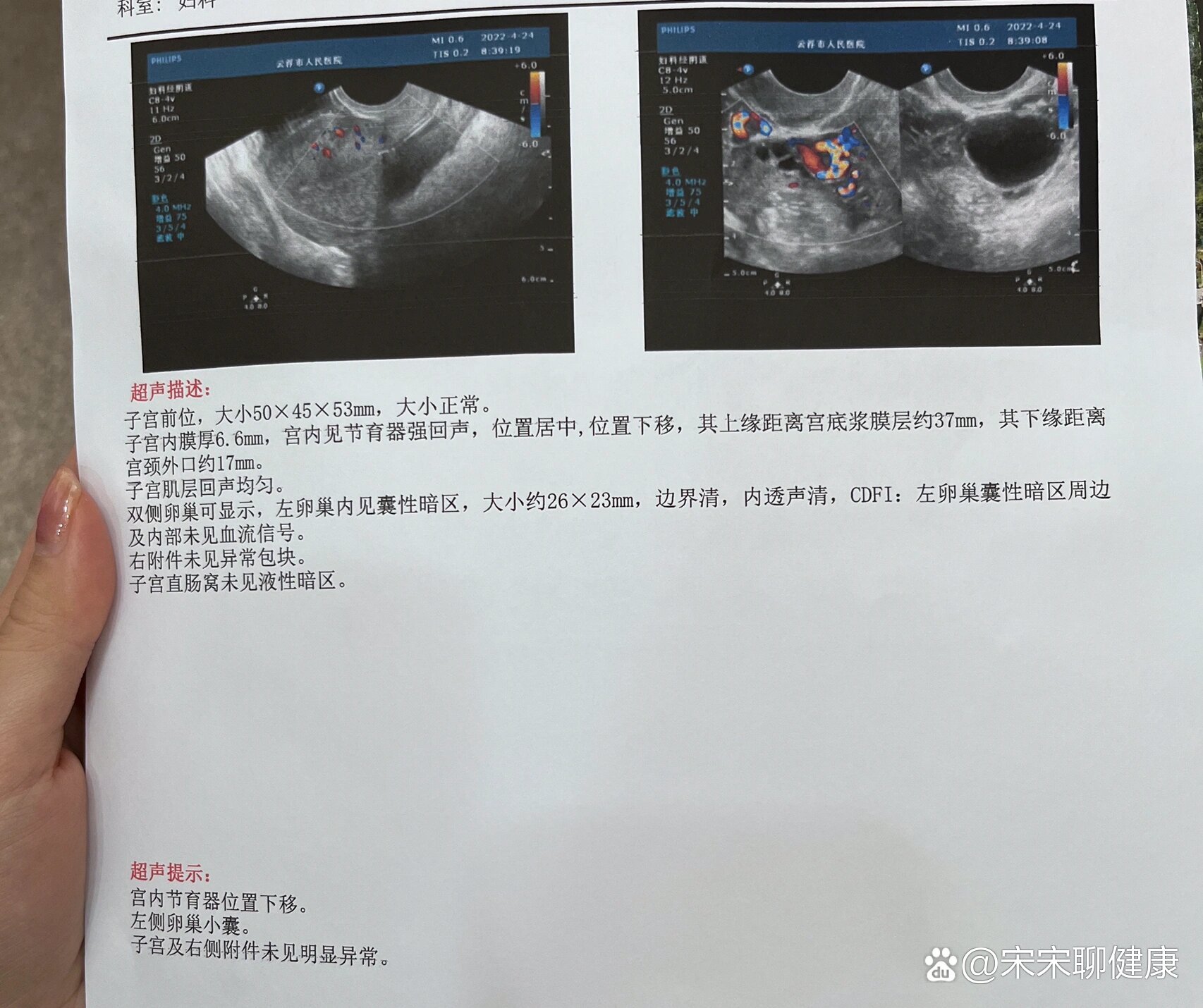 环下移到宫颈图片图片